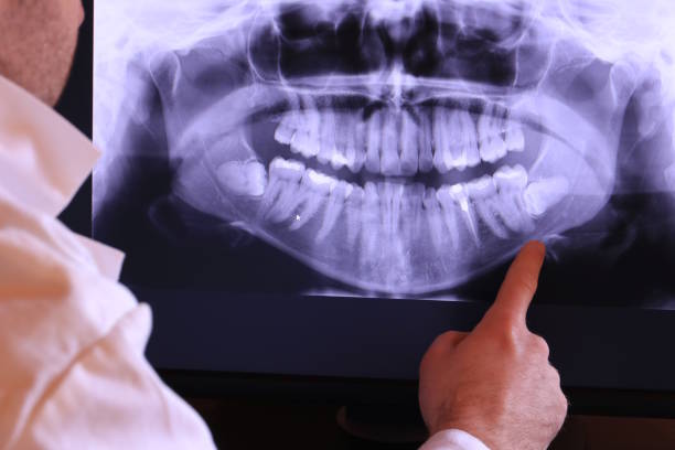 Best Emergency Tooth Extraction in Cresaptown, MD